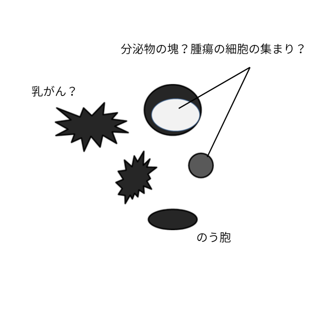 乳腺 嚢胞 と は